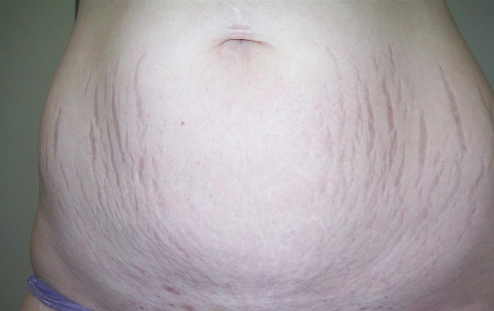 Stretch Marks Before Treatment